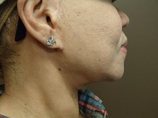 Facelift After
