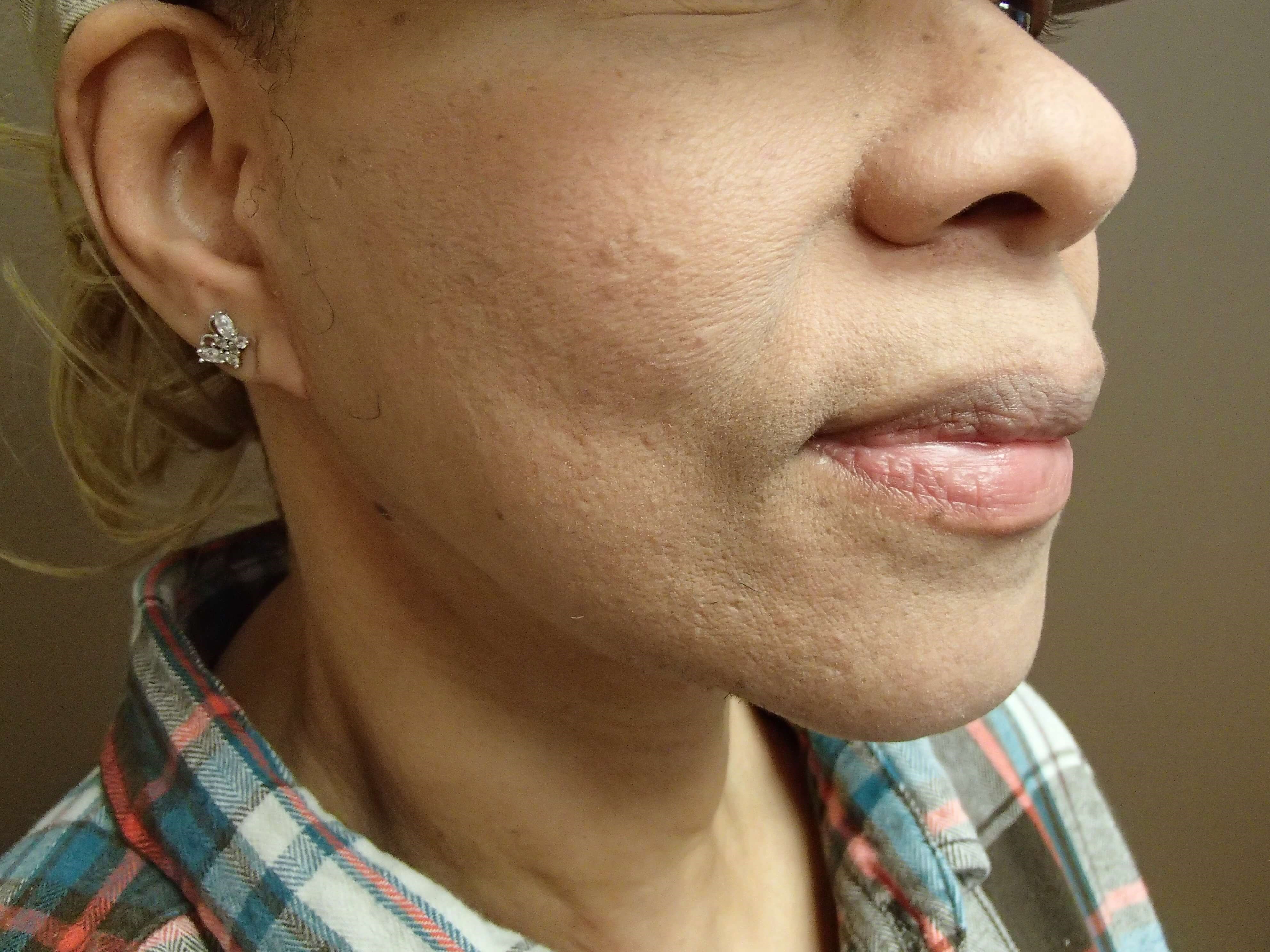 Facelift After