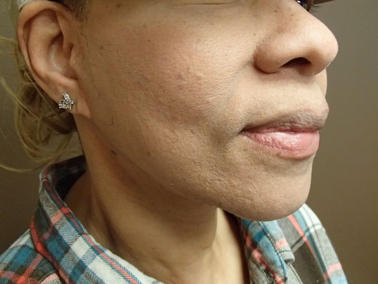 Facelift After