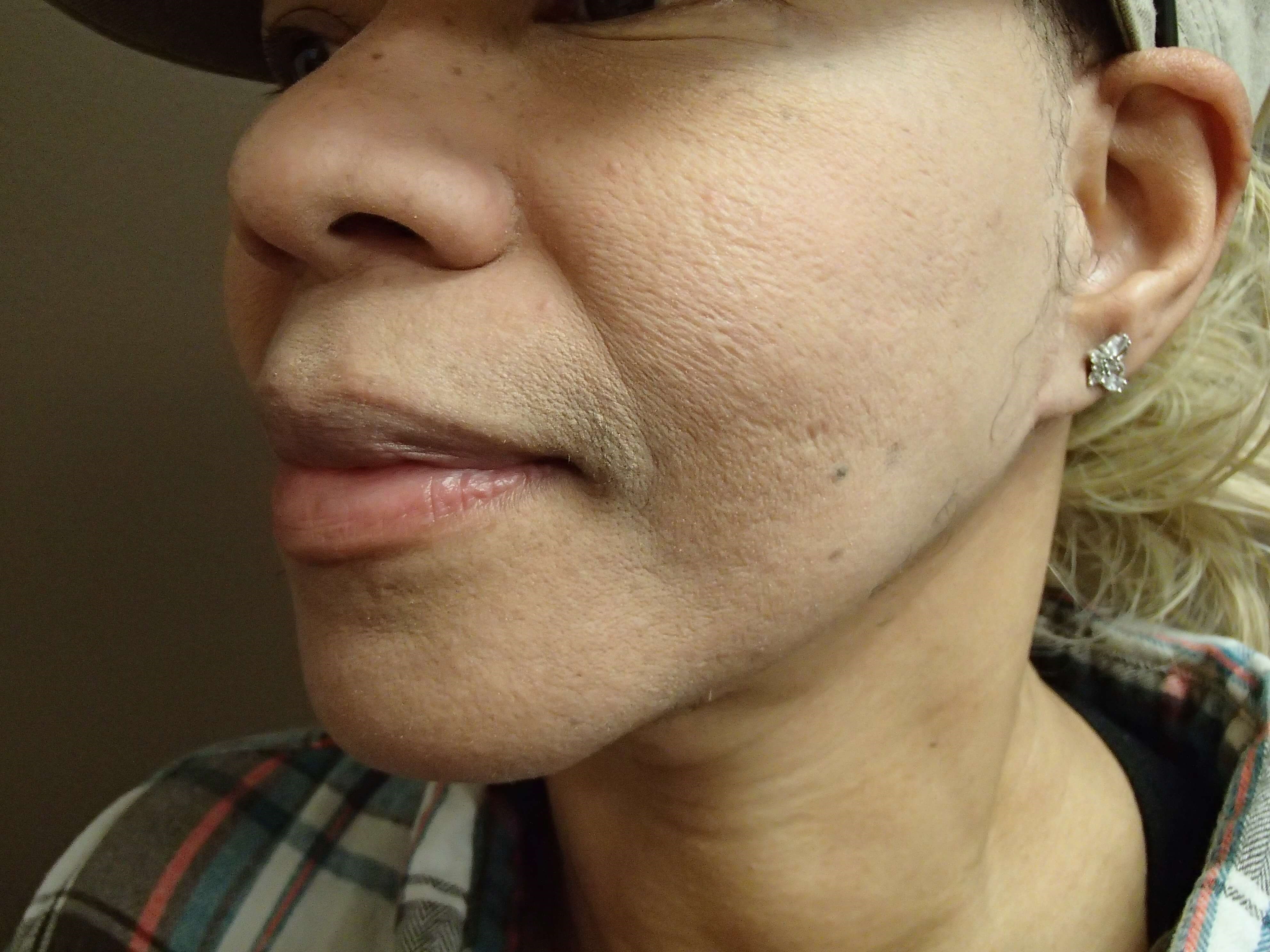 Facelift After