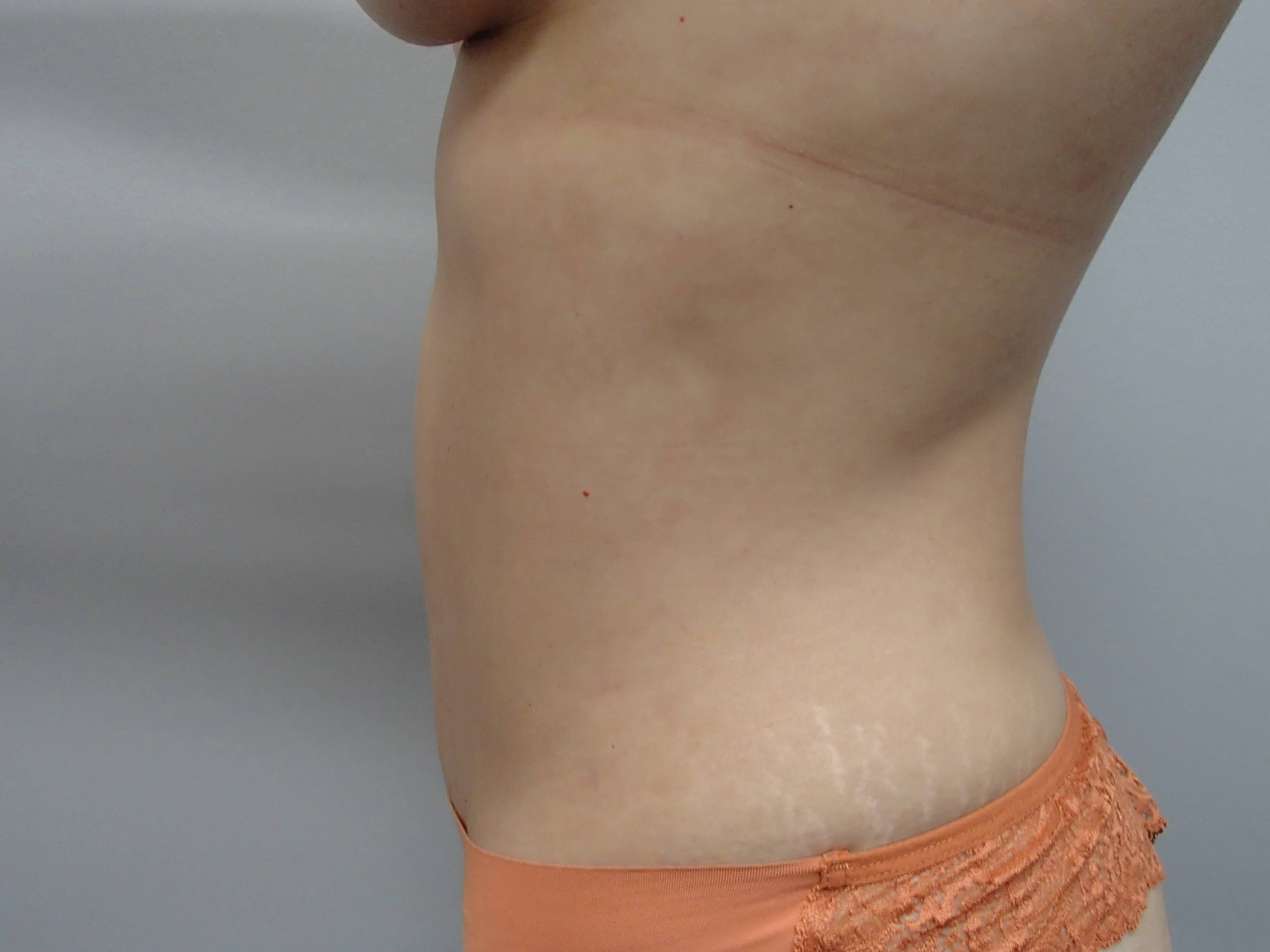 Timeless Tuck - Abdominoplasty After