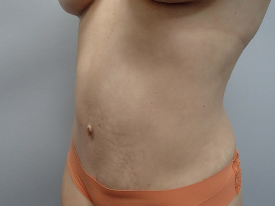 Timeless Tuck - Abdominoplasty After