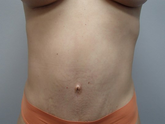 Timeless Tuck - Abdominoplasty After