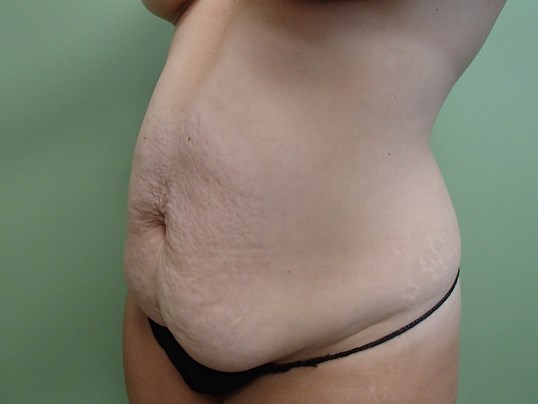 Timeless Tuck - Abdominoplasty Before