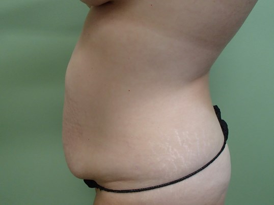Timeless Tuck - Abdominoplasty Before