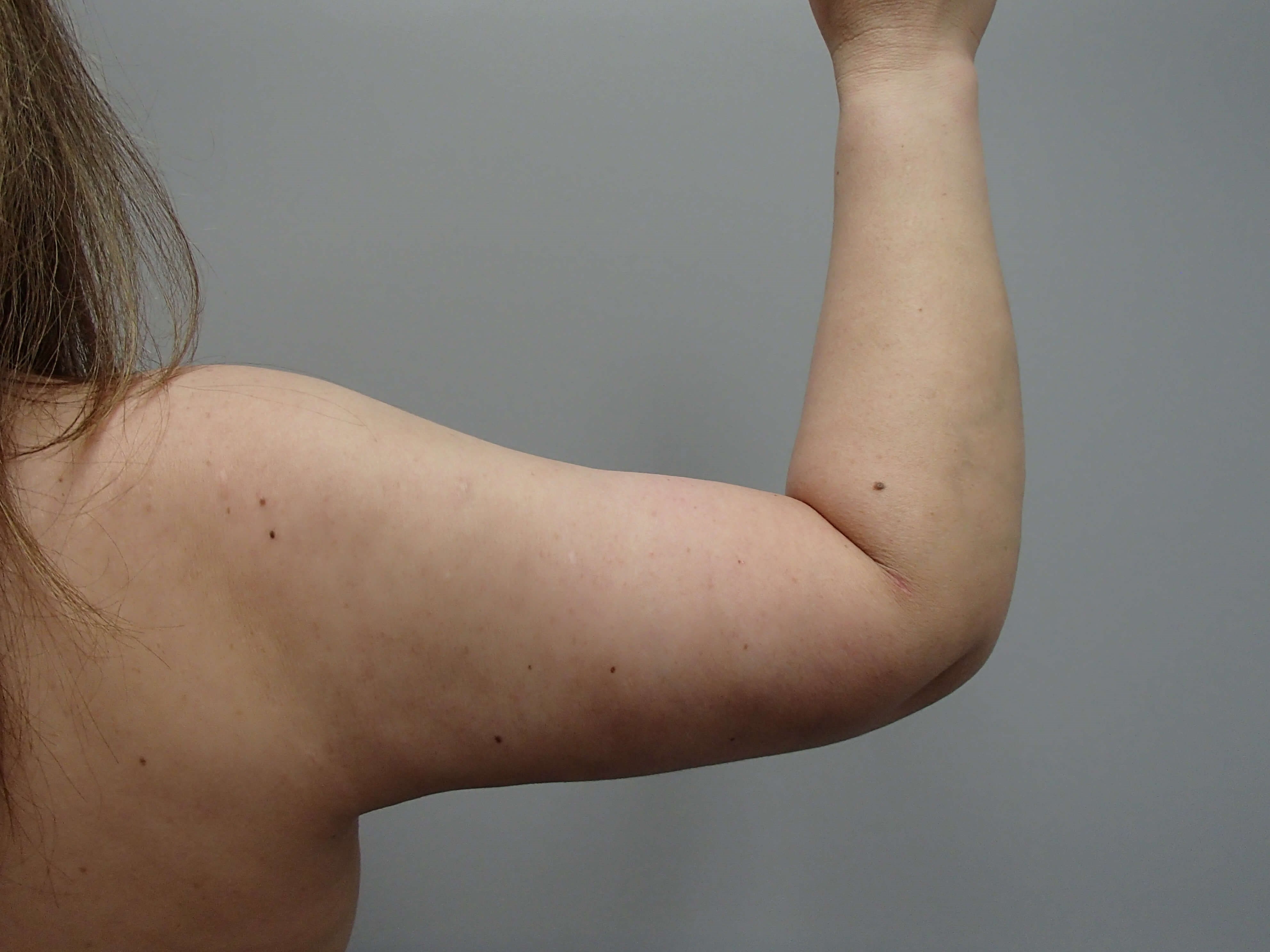 Brachioplasty (Arm Lift) After