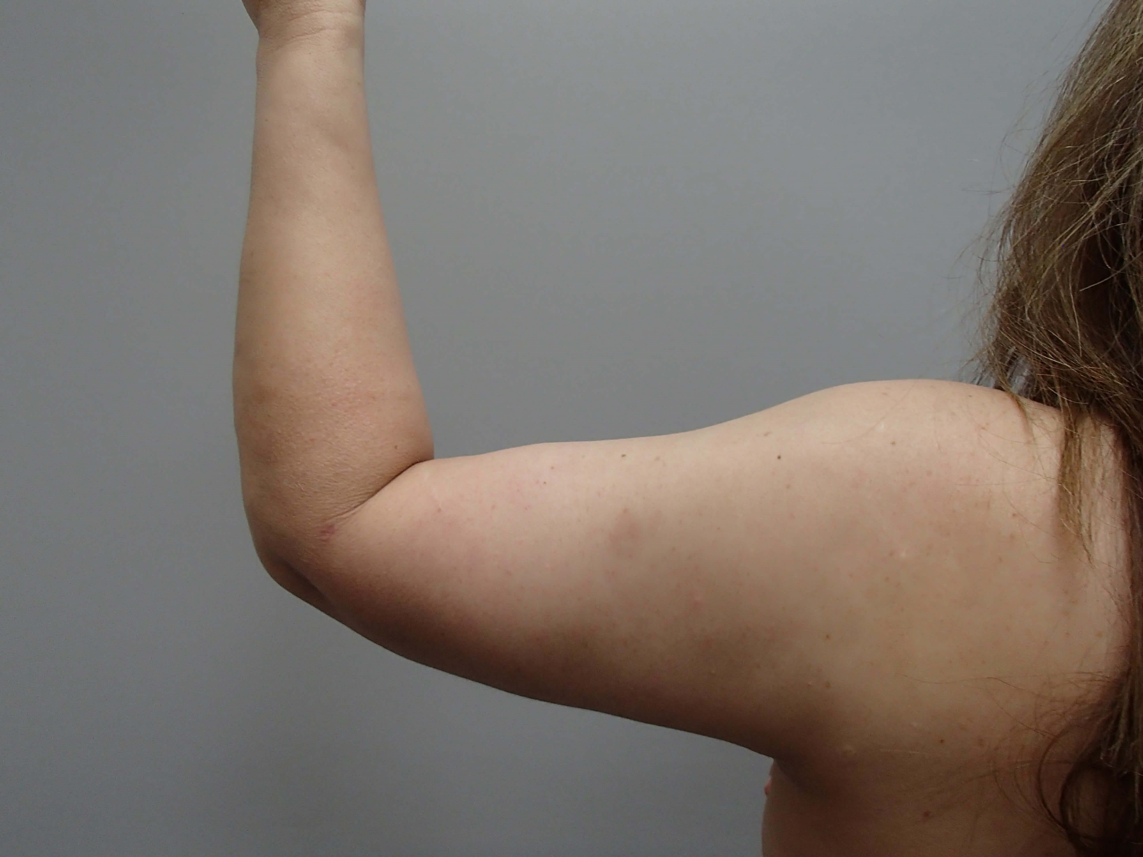 Brachioplasty (Arm Lift) After