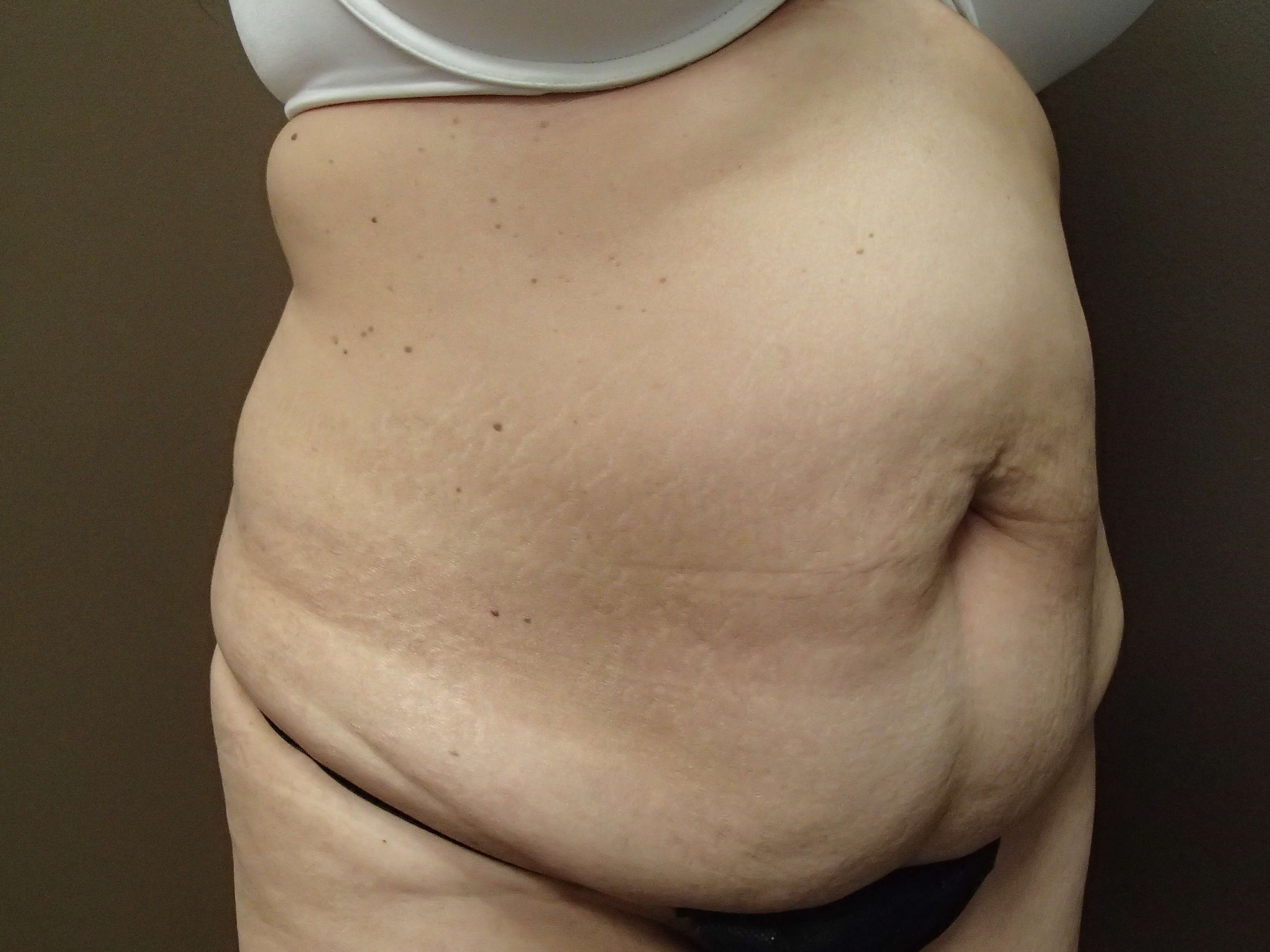 Timeless Tuck - Abdominoplasty Before