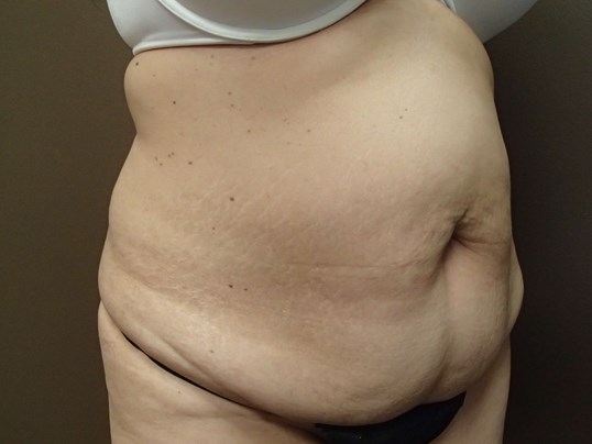 Timeless Tuck - Abdominoplasty Before