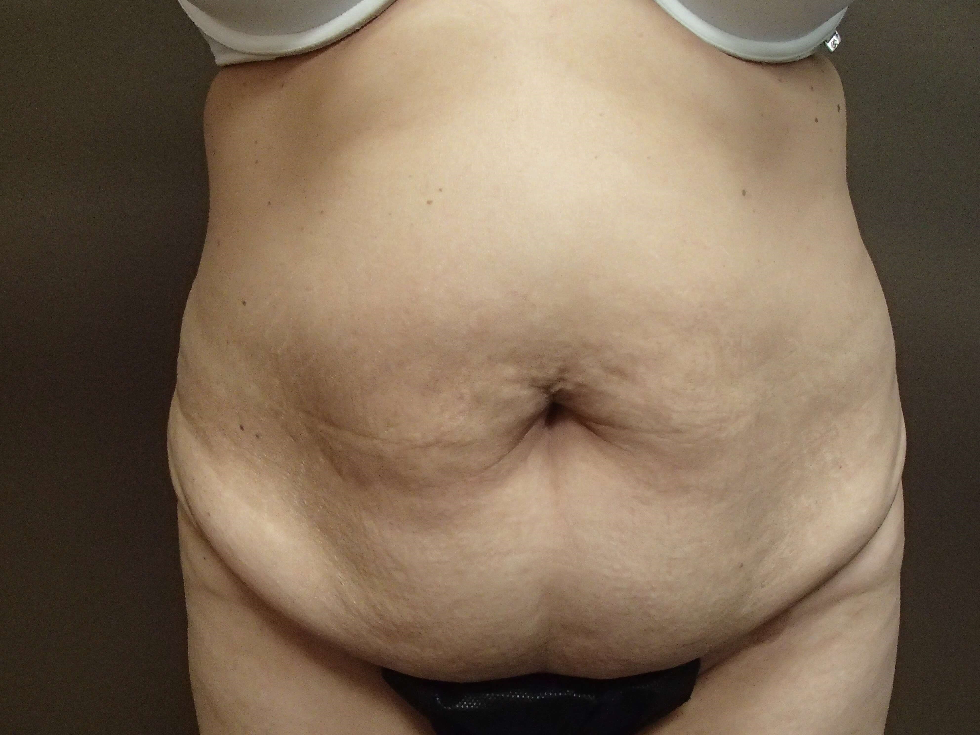 Timeless Tuck - Abdominoplasty Before