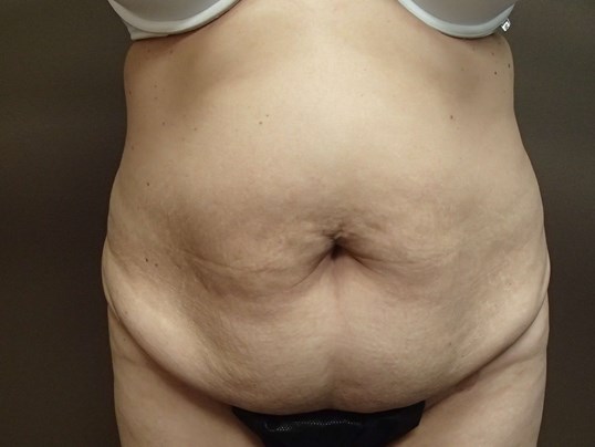 Timeless Tuck - Abdominoplasty Before
