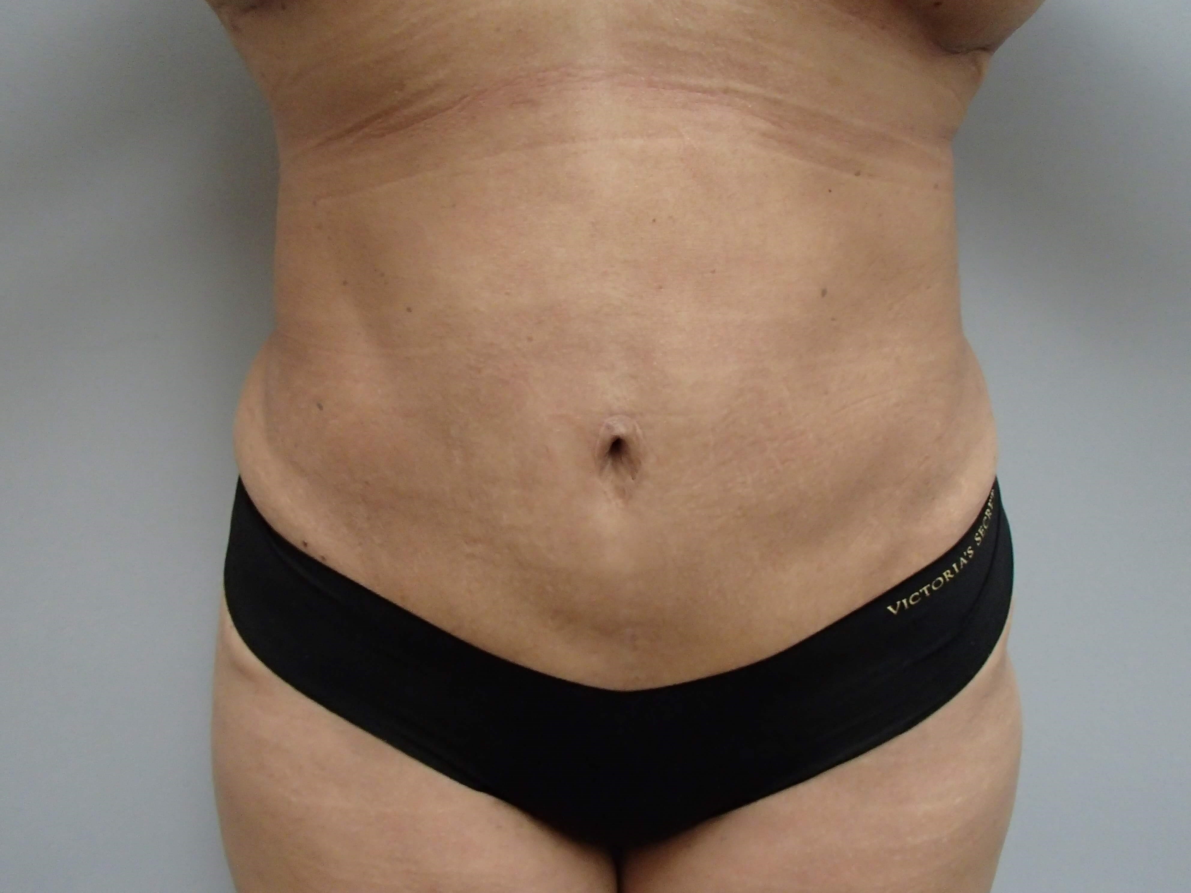 Timeless Tuck - Abdominoplasty After