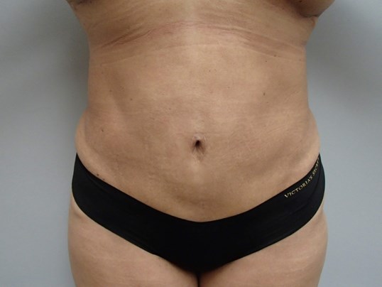 Timeless Tuck - Abdominoplasty After