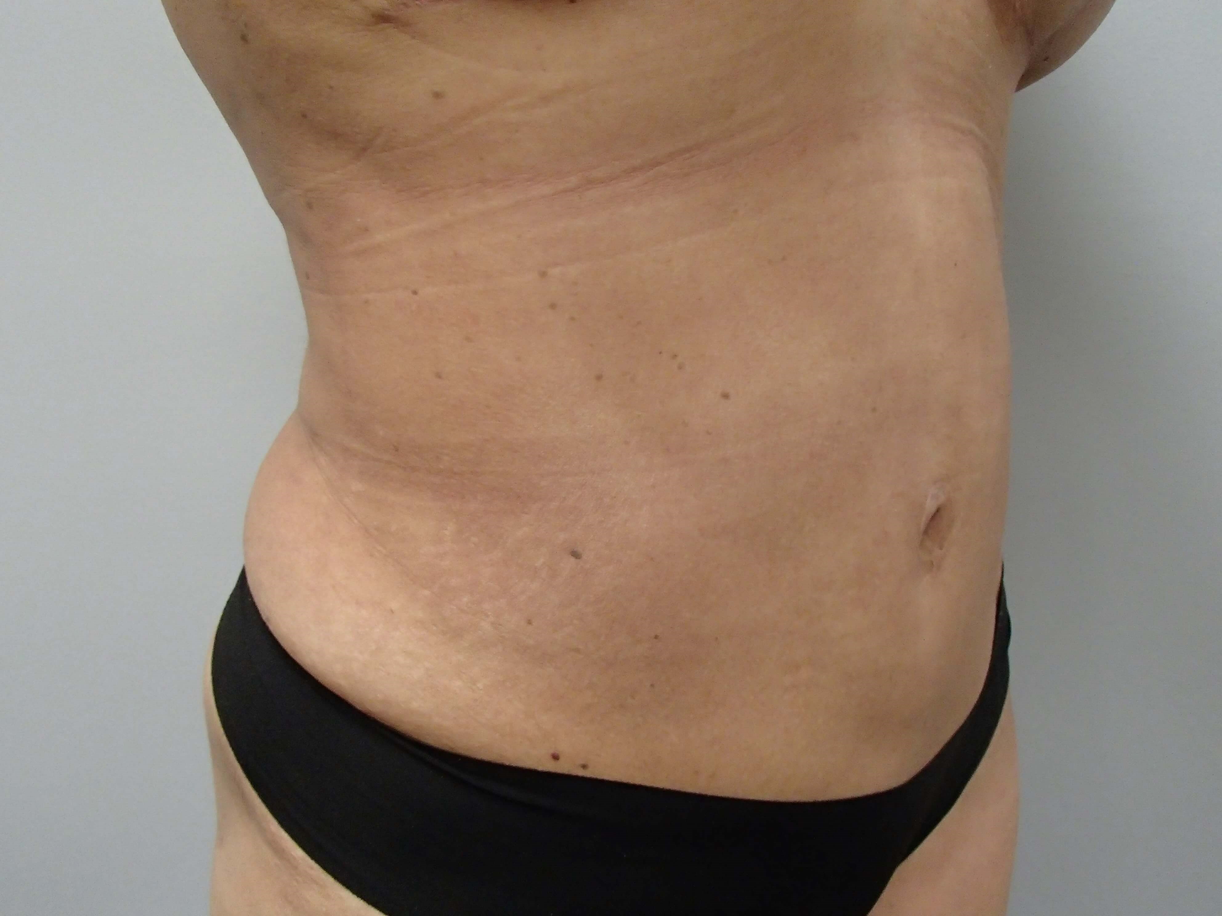 Timeless Tuck - Abdominoplasty After