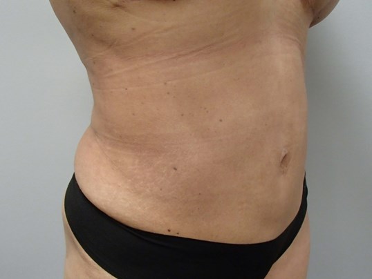 Timeless Tuck - Abdominoplasty After