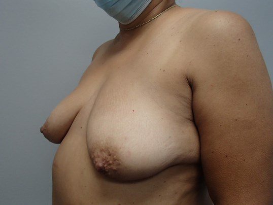 Breast Lift WITH Implants Before