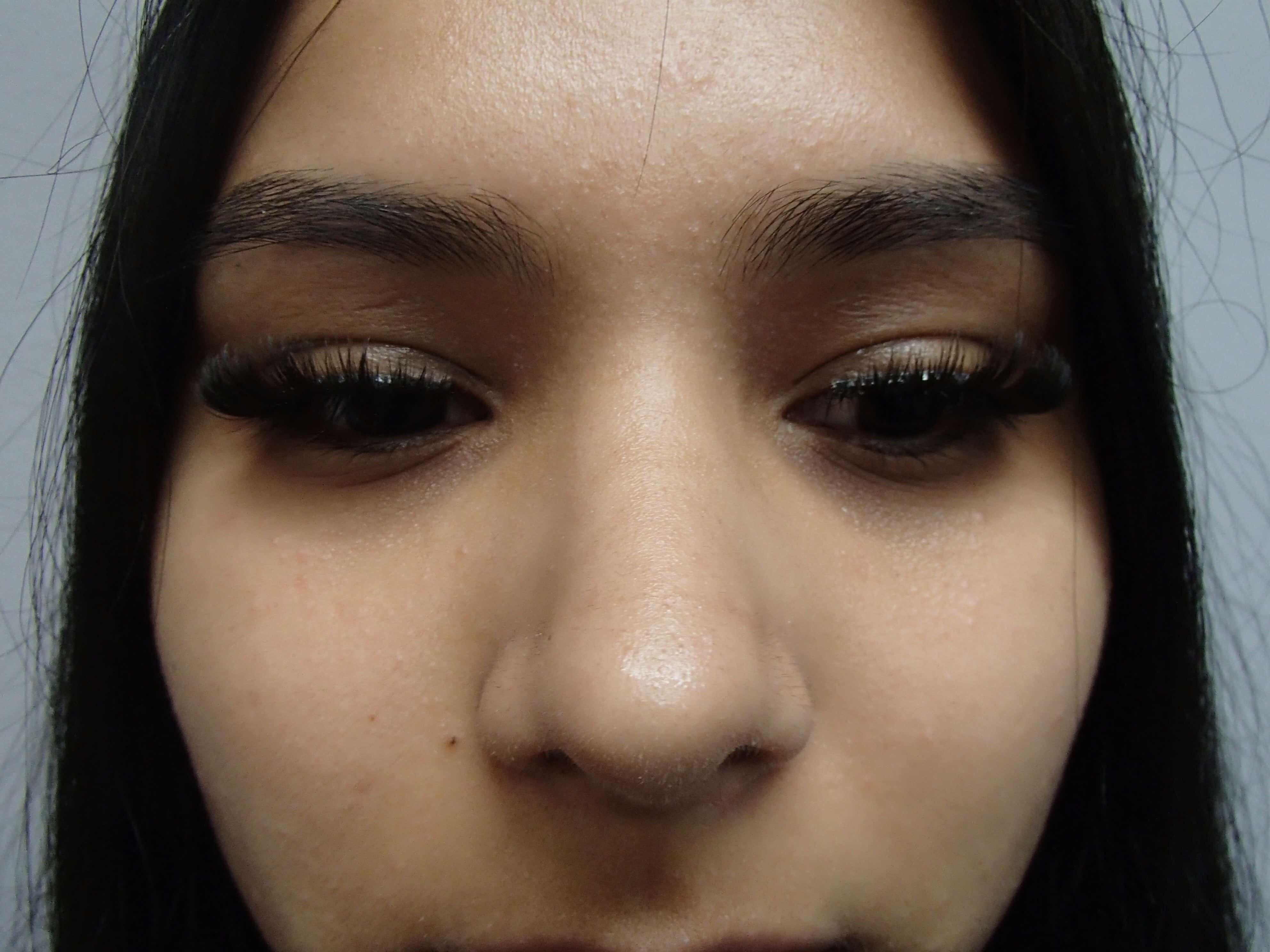 Rhinoplasty After