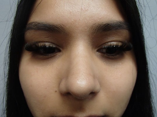 Rhinoplasty After