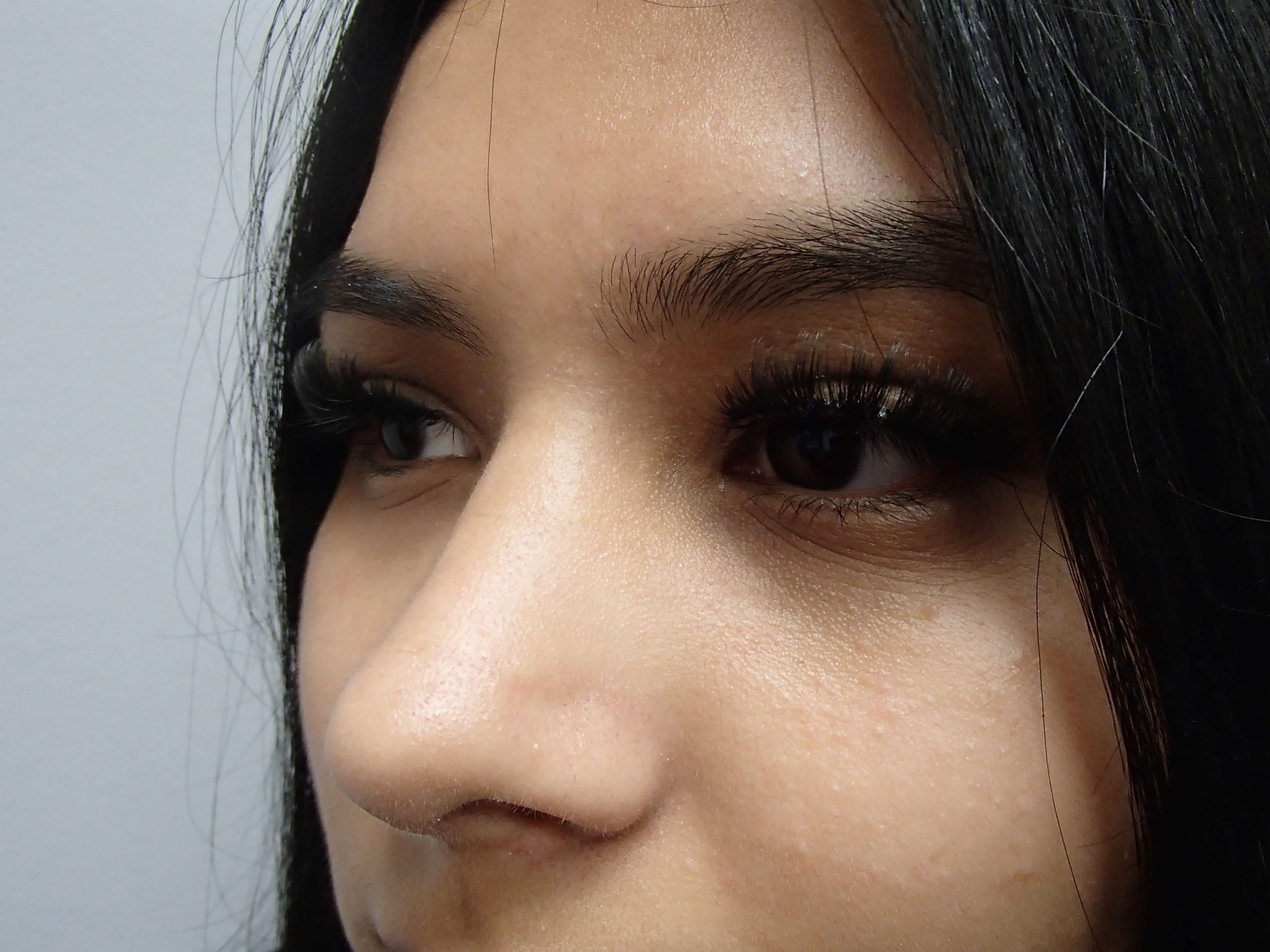 Rhinoplasty After