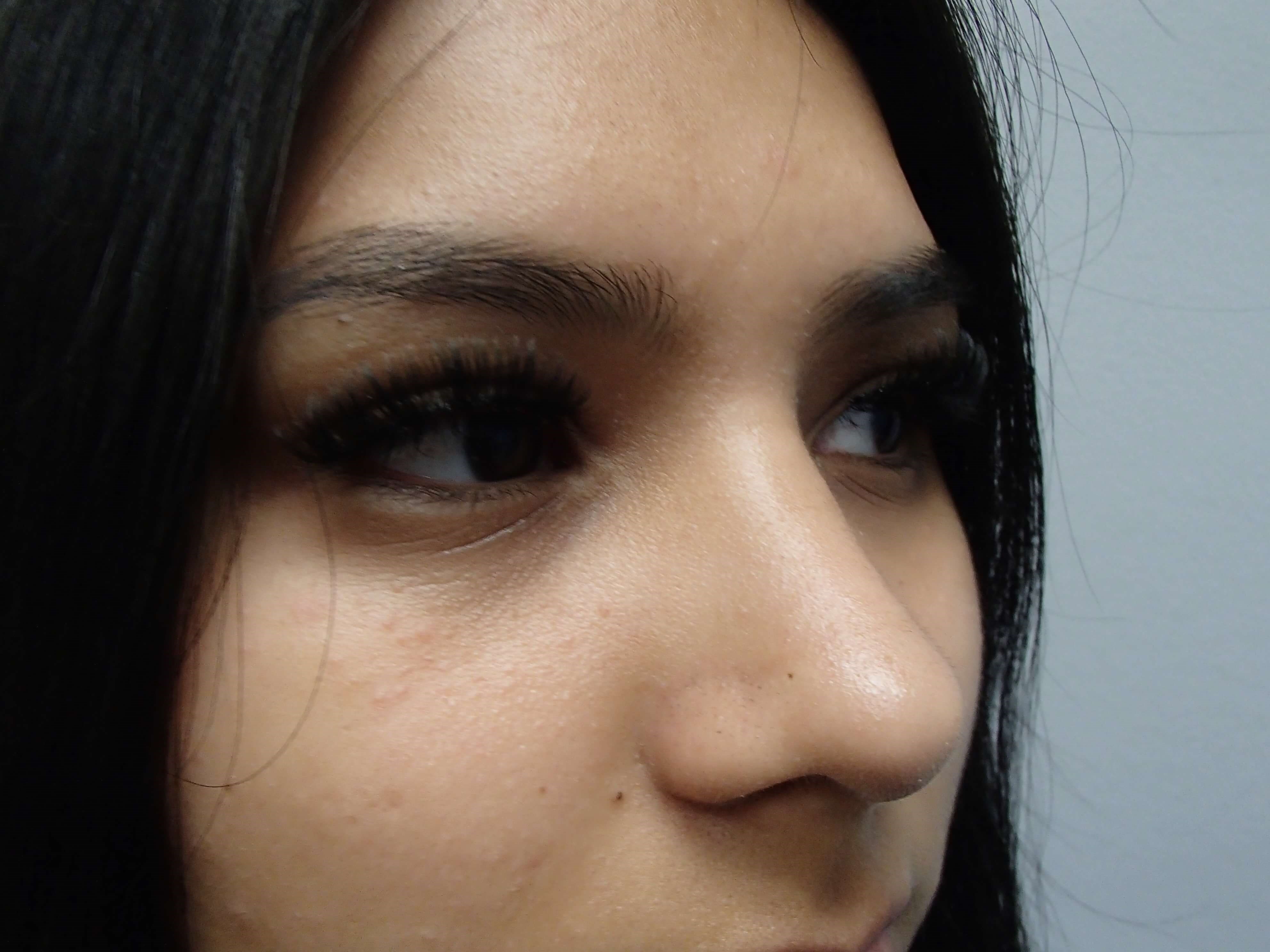 Rhinoplasty After