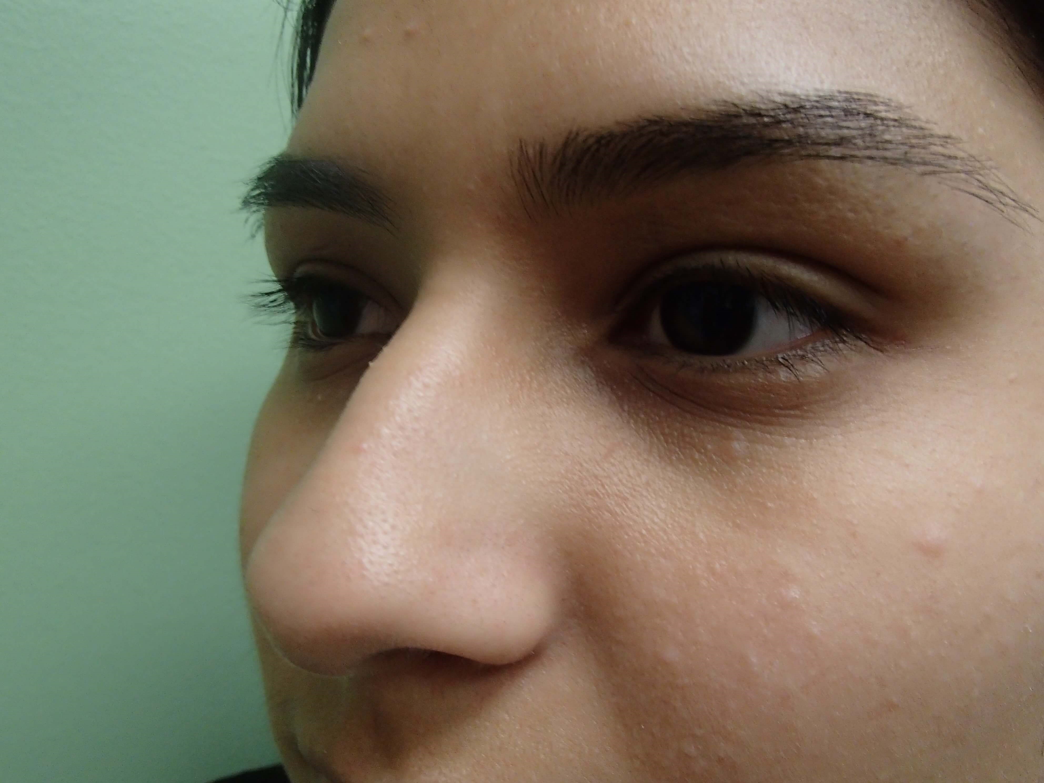 Rhinoplasty Before