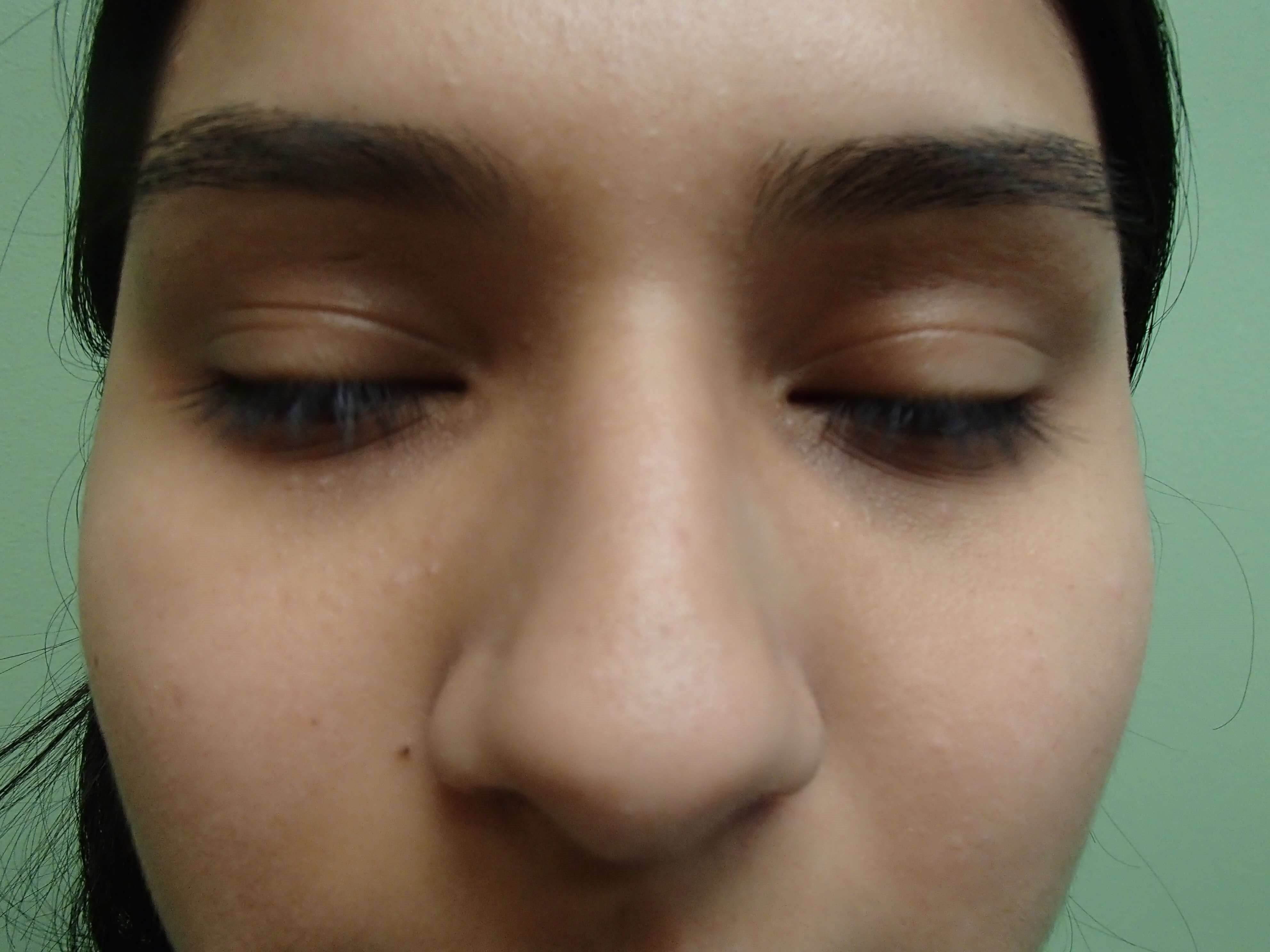Rhinoplasty Before