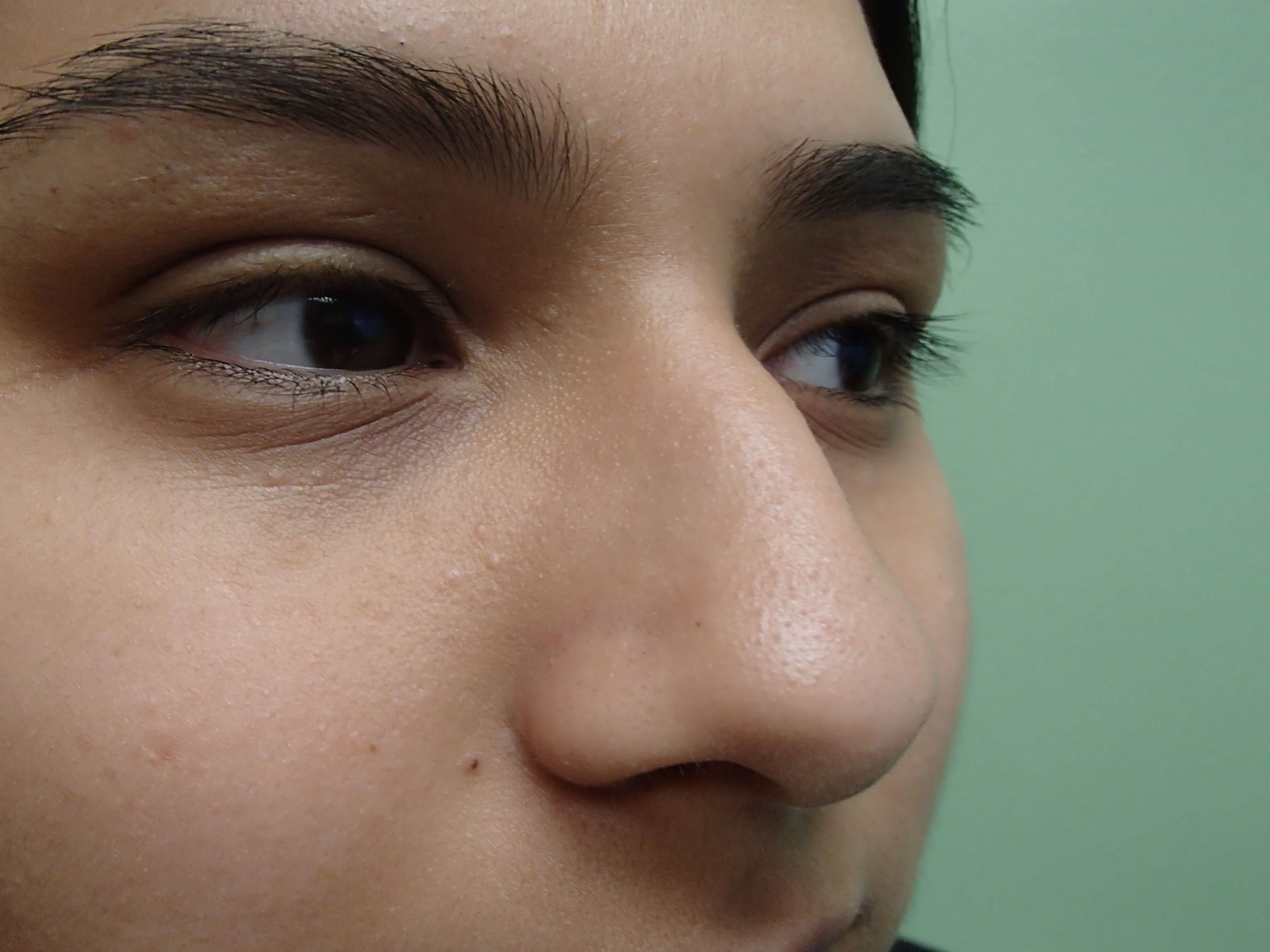 Rhinoplasty Before