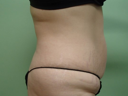 Timeless Tuck - Abdominoplasty Before