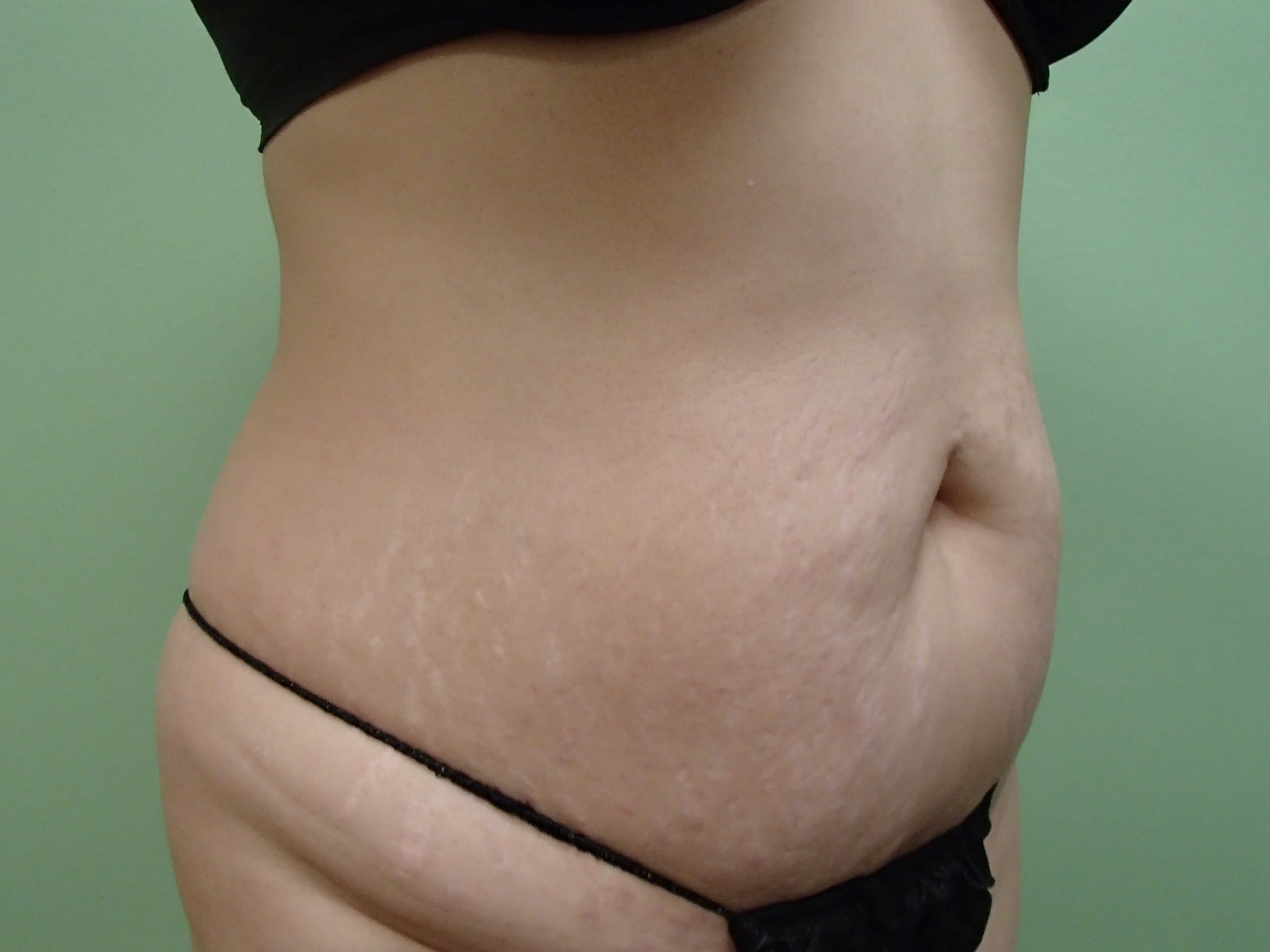 Timeless Tuck - Abdominoplasty Before