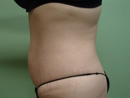 Timeless Tuck - Abdominoplasty Before