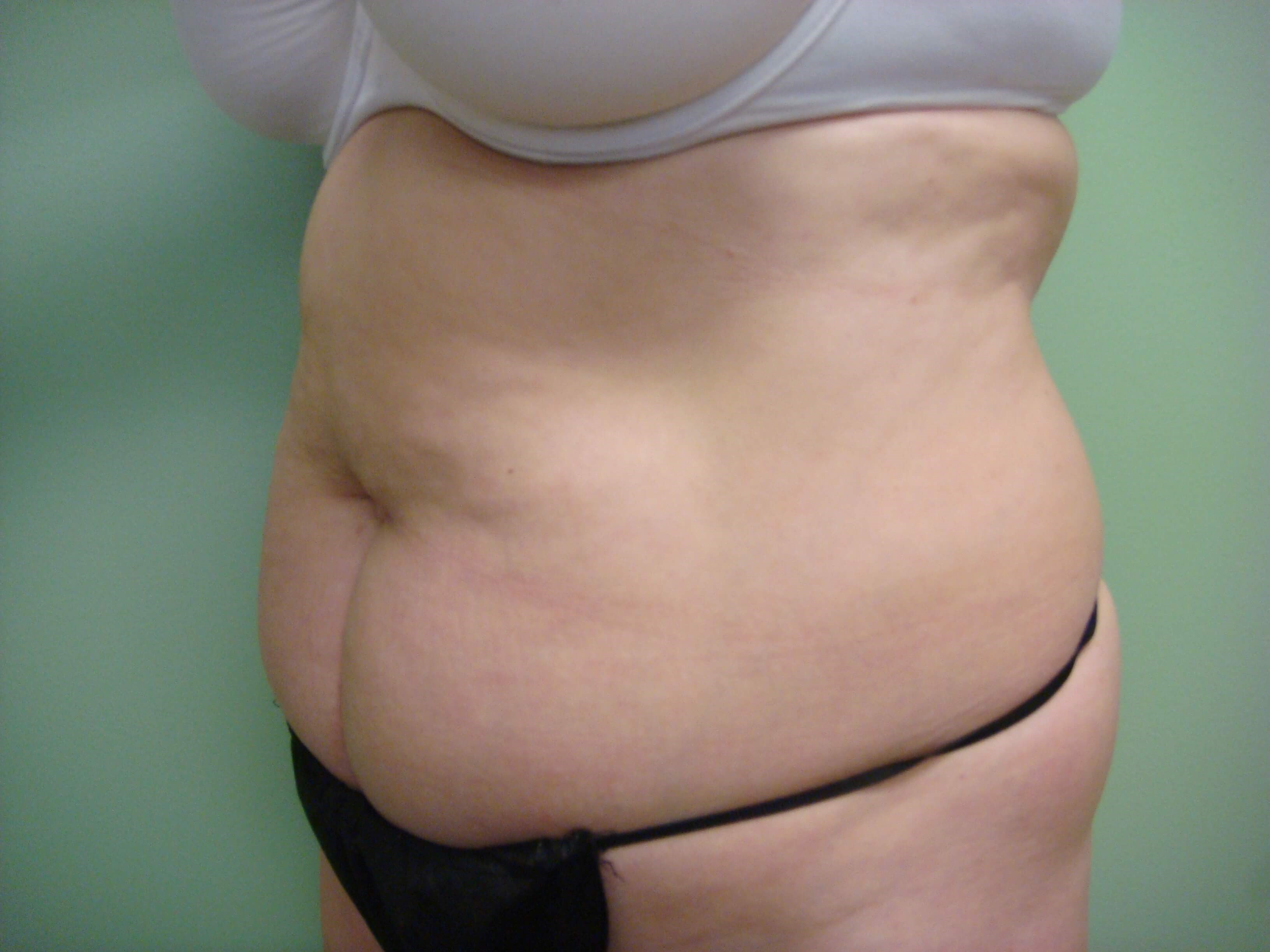 Timeless Tuck - Abdominoplasty Before