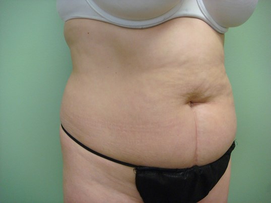 Timeless Tuck - Abdominoplasty Before