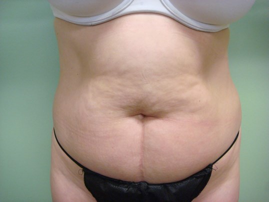 Timeless Tuck - Abdominoplasty Before