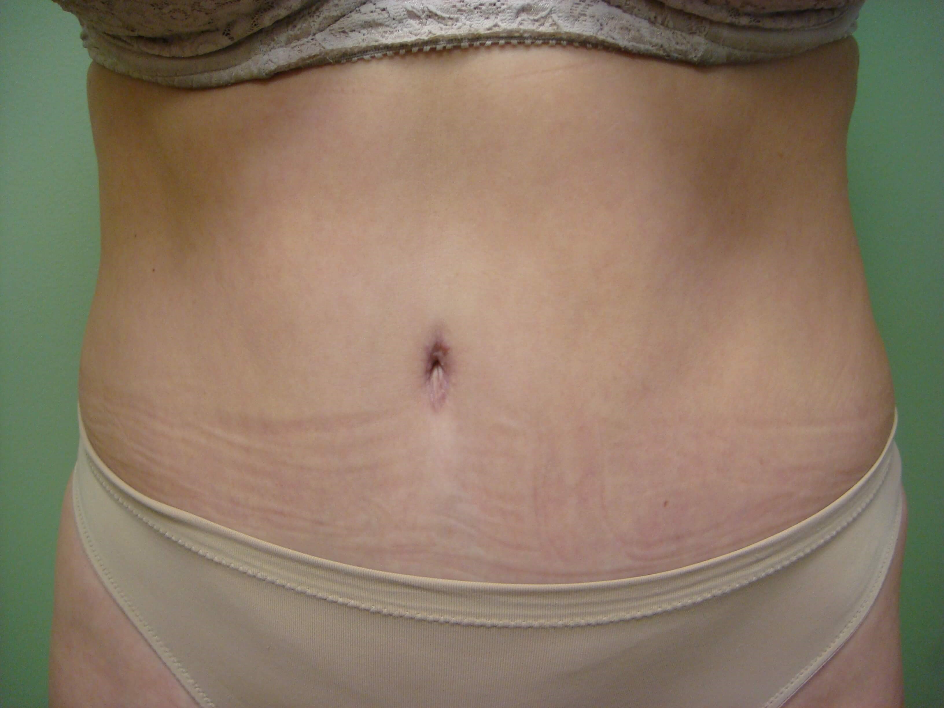 Timeless Tuck - Abdominoplasty After