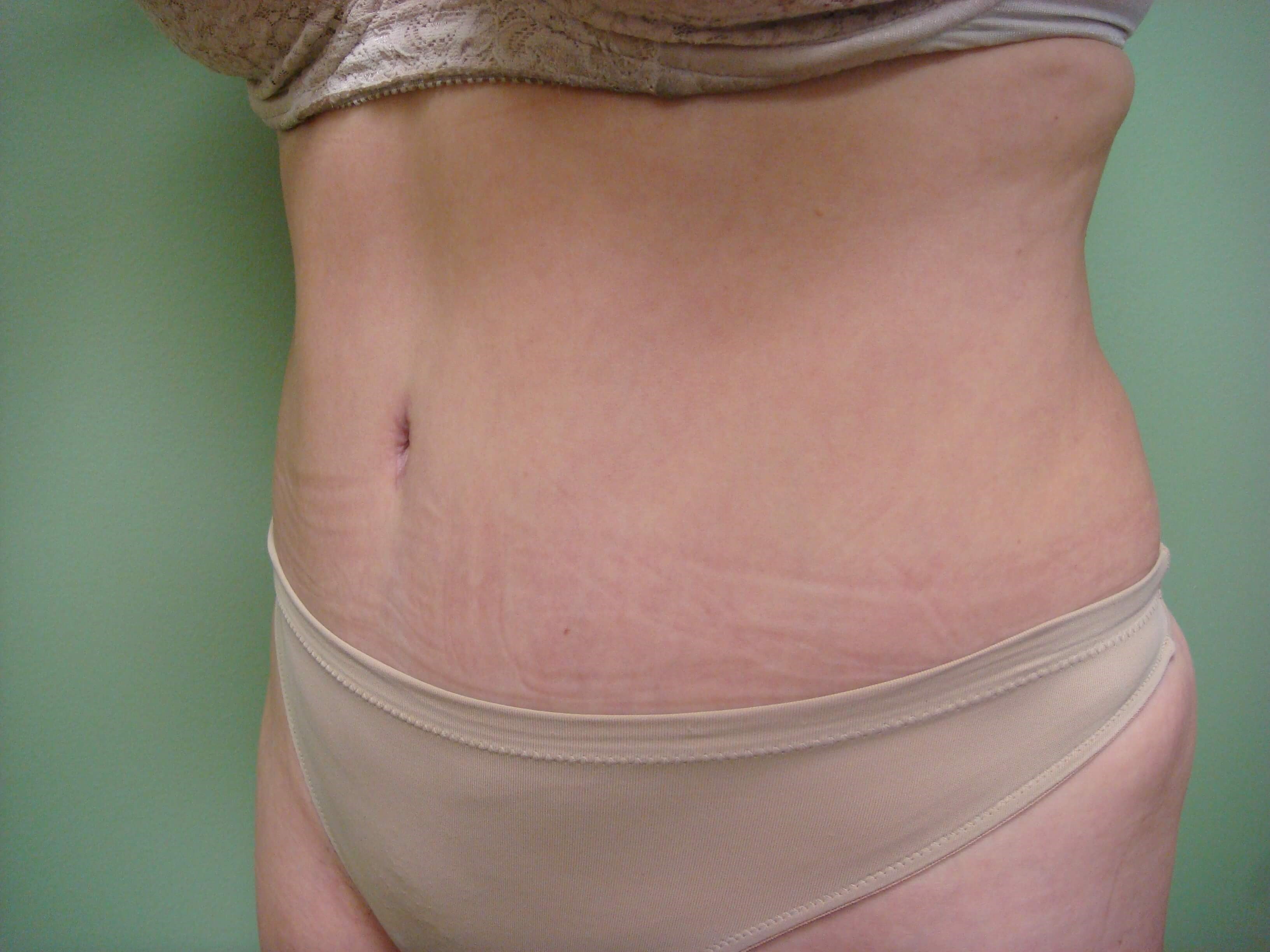 Timeless Tuck - Abdominoplasty After