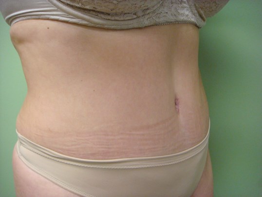 Timeless Tuck - Abdominoplasty After