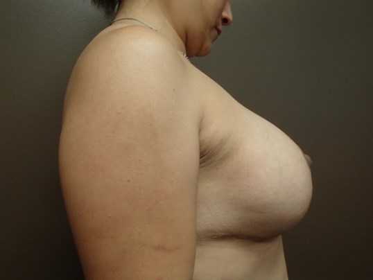 Mastopexy (Lift) with Implants After