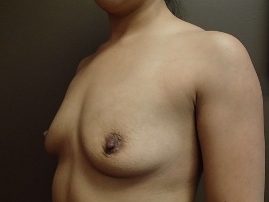 Breast Augmentation- silicone Before