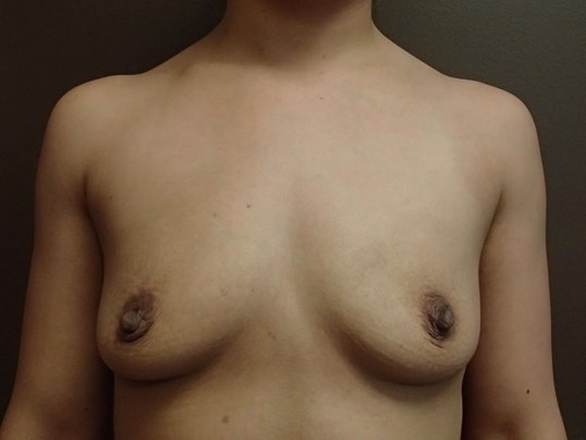 Breast Augmentation- silicone Before