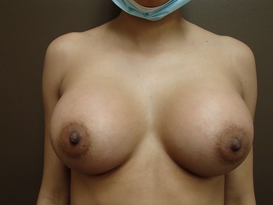 Breast Augmentation- silicone After