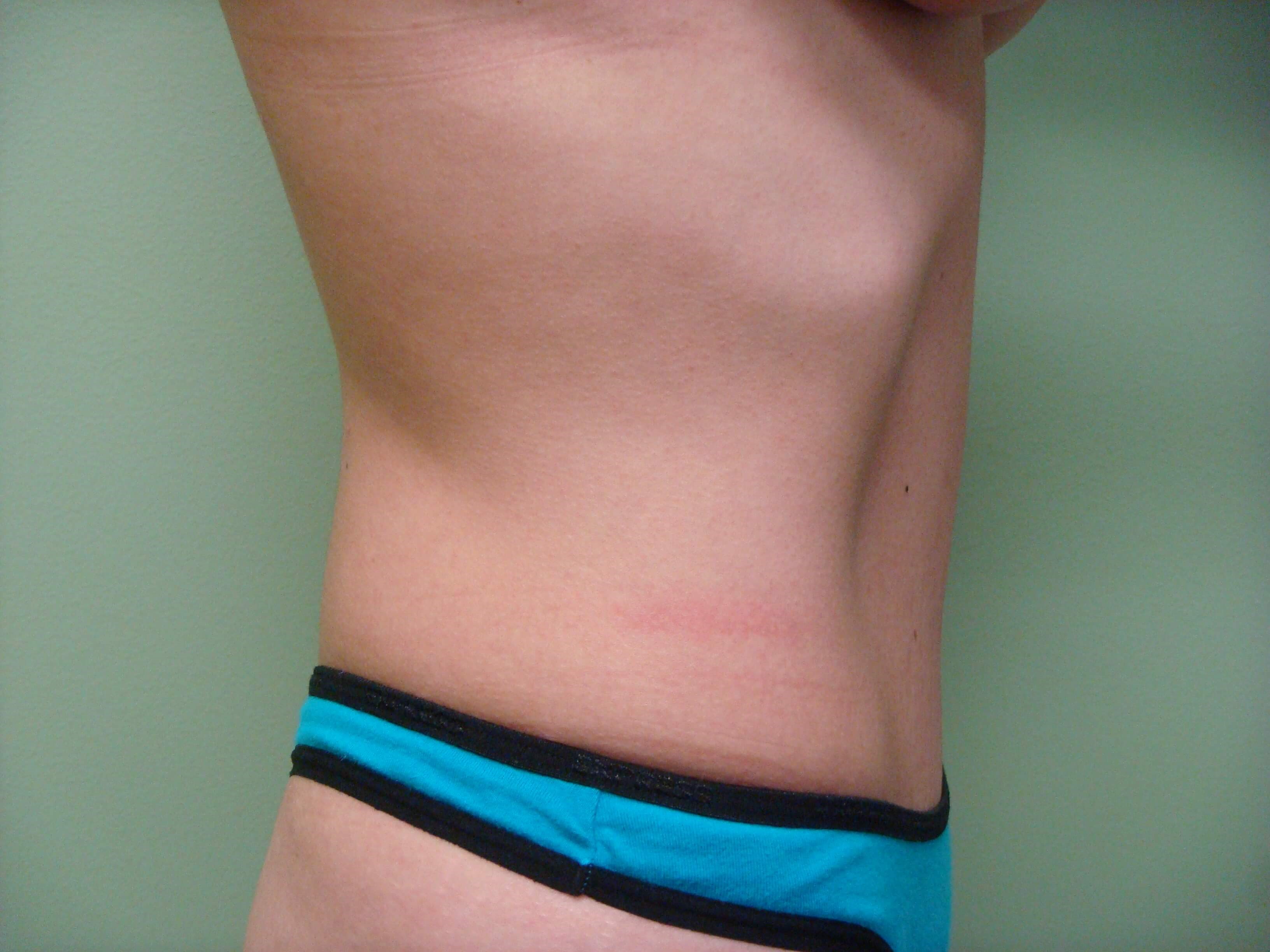 Timeless Tuck - Abdominoplasty After