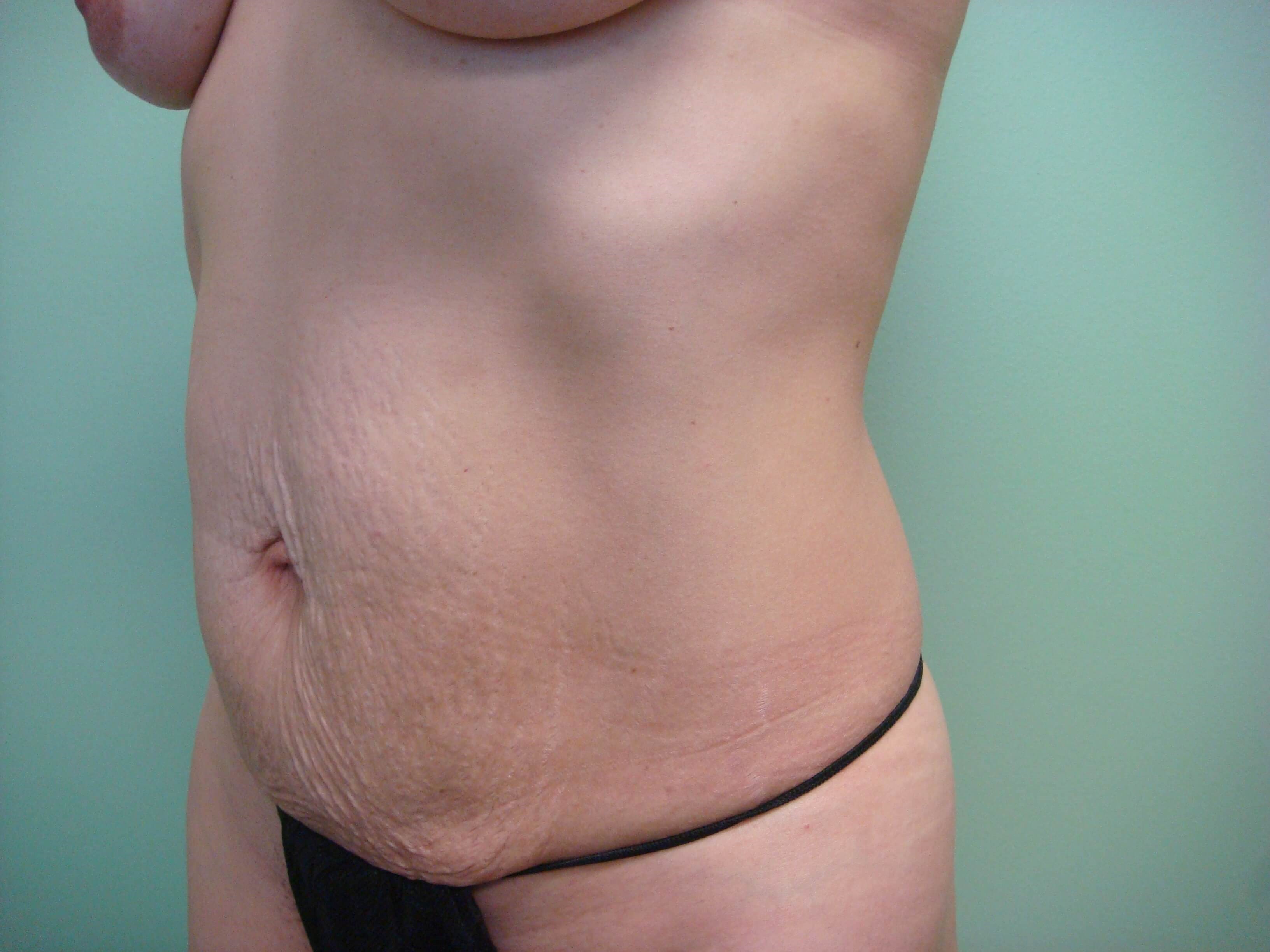 Timeless Tuck - Abdominoplasty Before