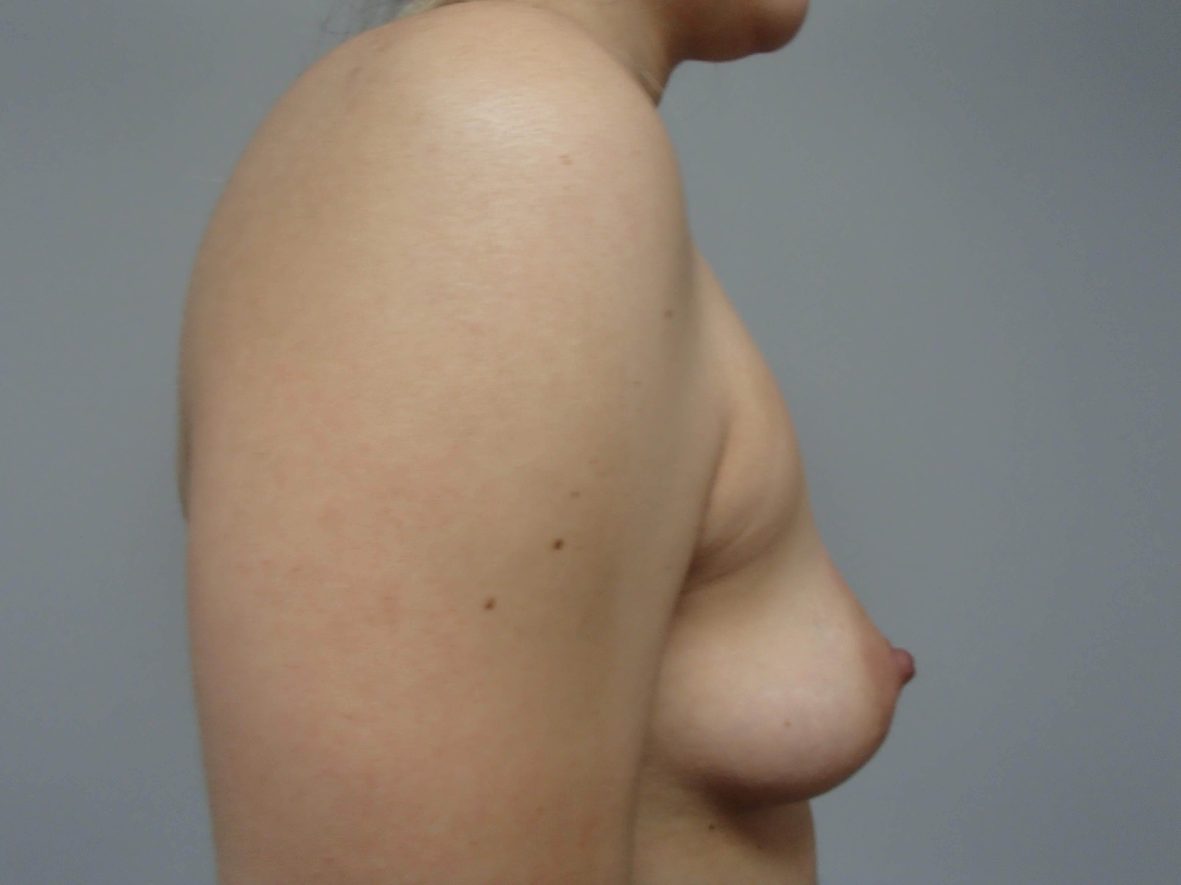 Breast Augmentation- silicone Before