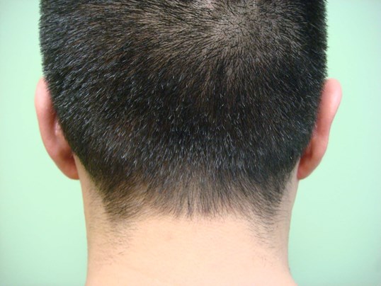 Ear Surgery - Otoplasty After