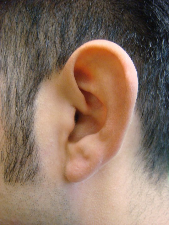 Otoplasty - Ear Surgery Before