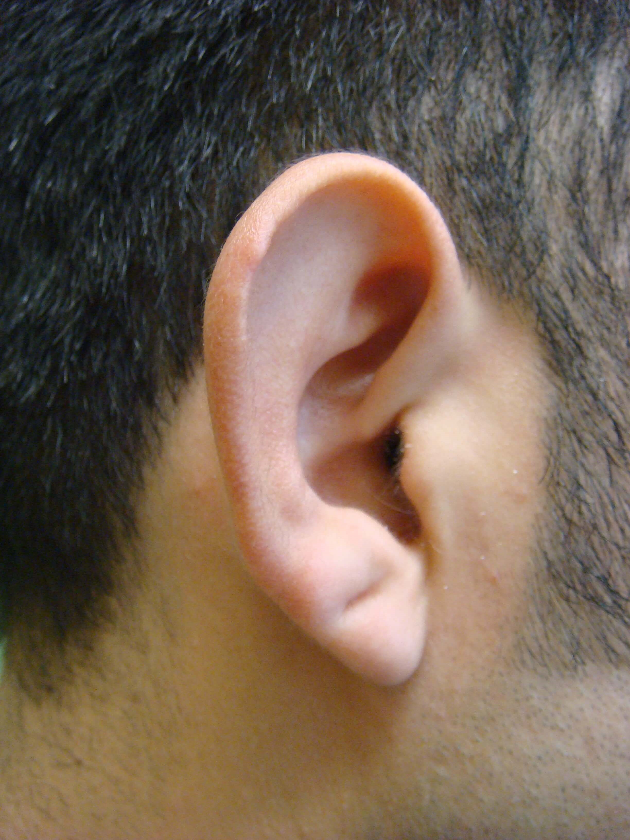 Otoplasty - Ear Surgery Before