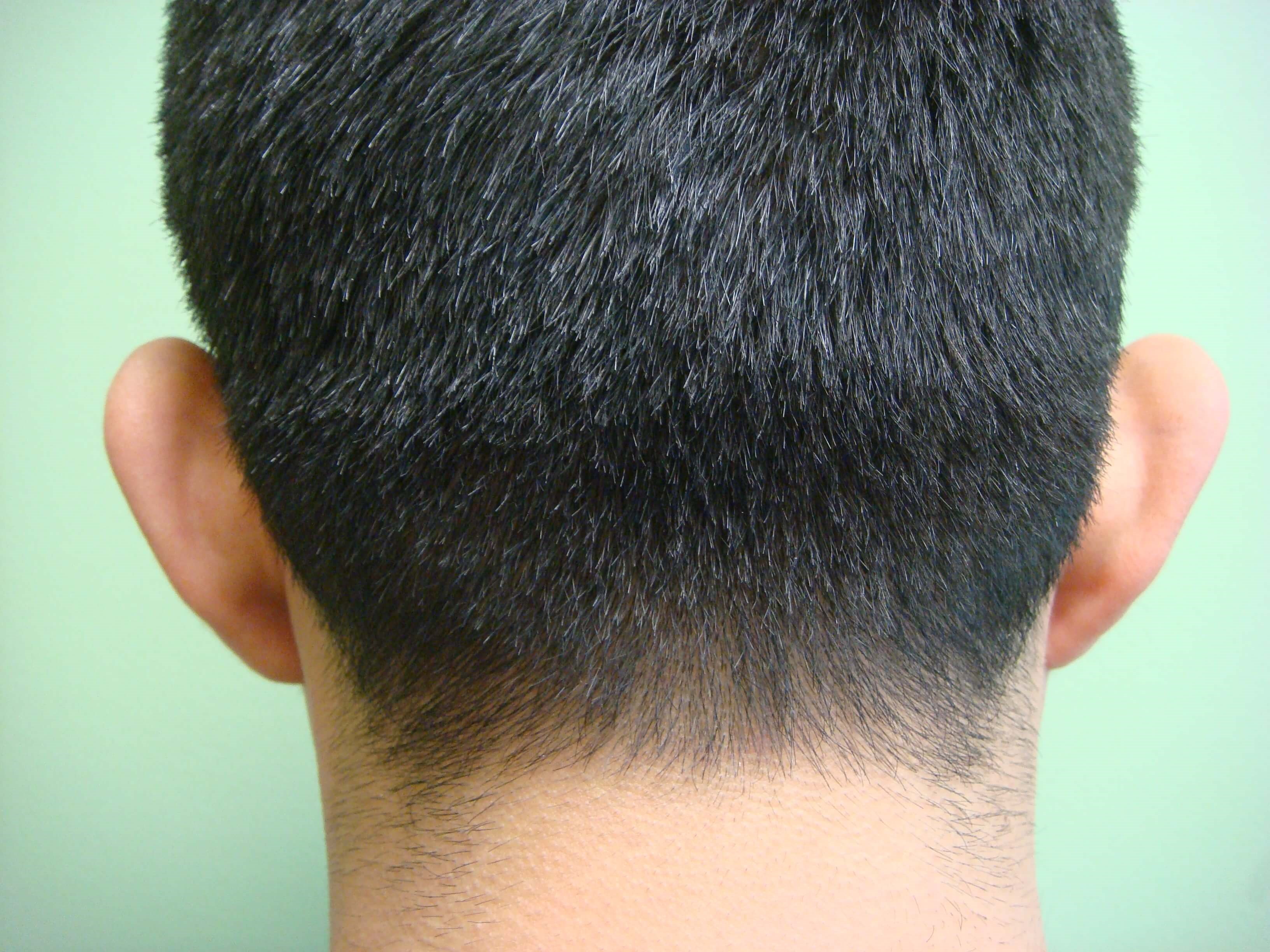 Ear Surgery - Otoplasty Before