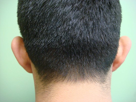 Ear Surgery - Otoplasty Before