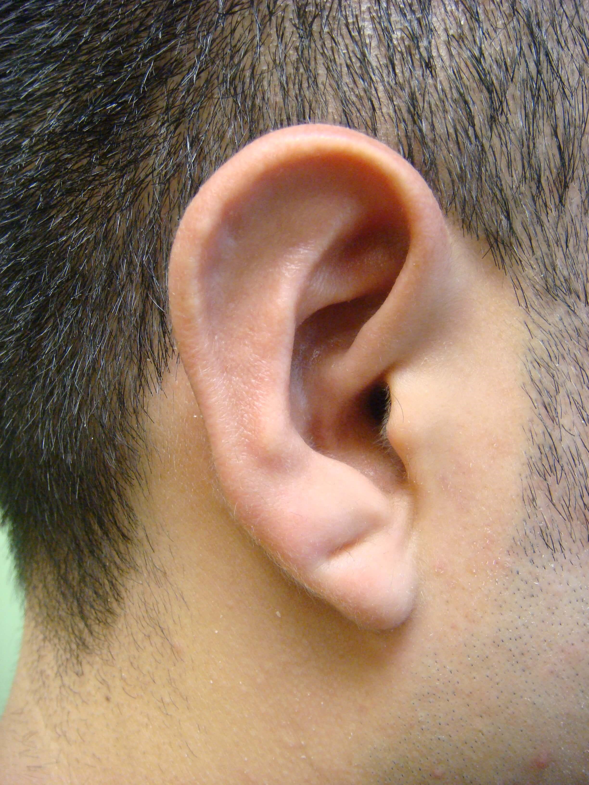 Otoplasty - Ear Surgery After