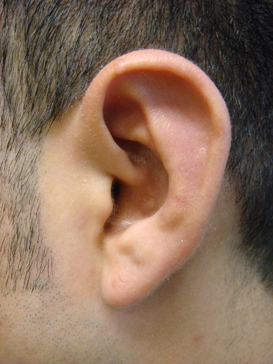 Otoplasty - Ear Surgery After